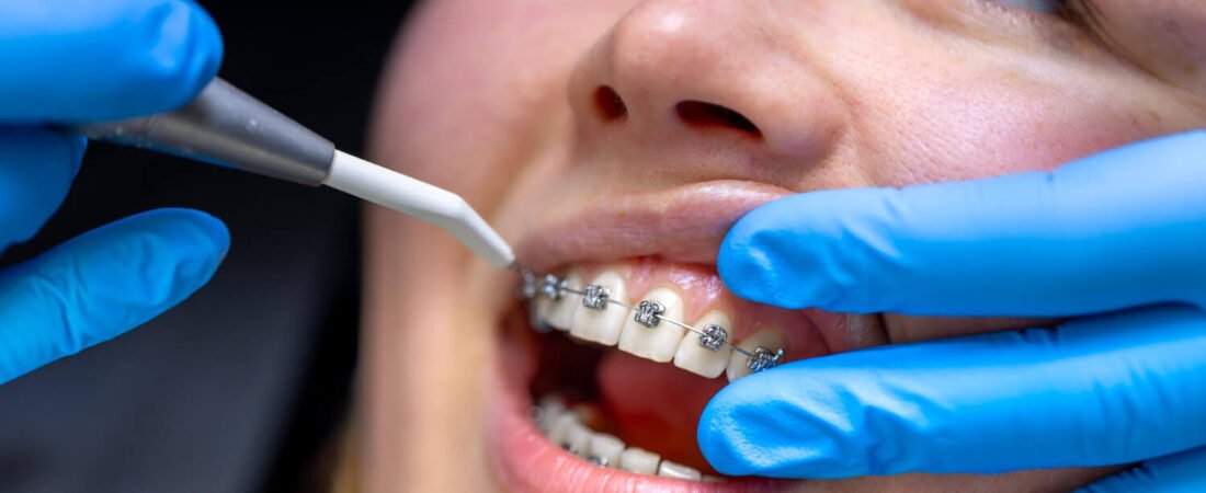 הדרכים המתקדמות ביותר לטיפול יישור שיניים